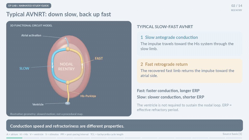 Physician sketches AVNRT cardiac diagram with GPT-6 Astra in two minutes